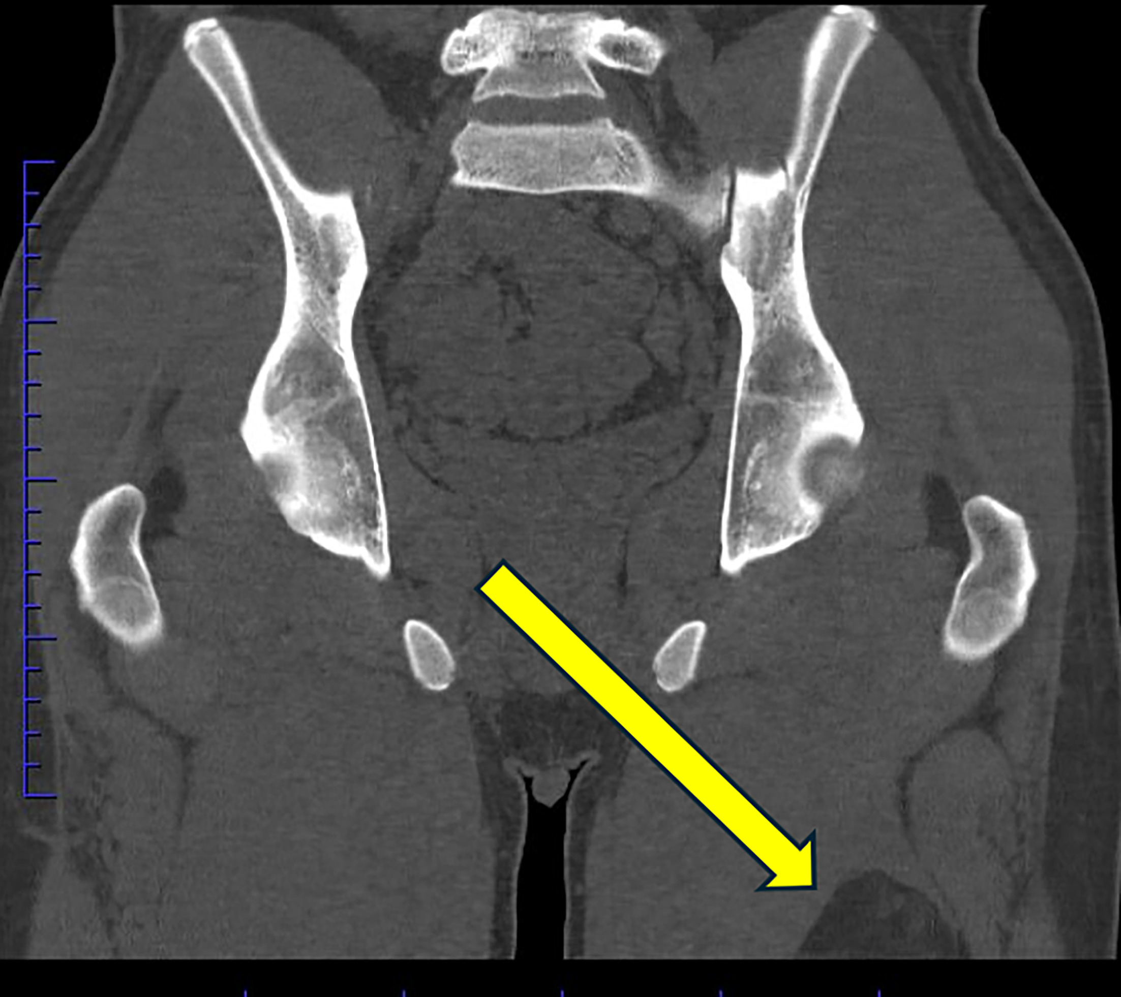 Coronal nonenhanced CT of the pelvis showing hypodense mass incompletely included in the field of view (arrows).