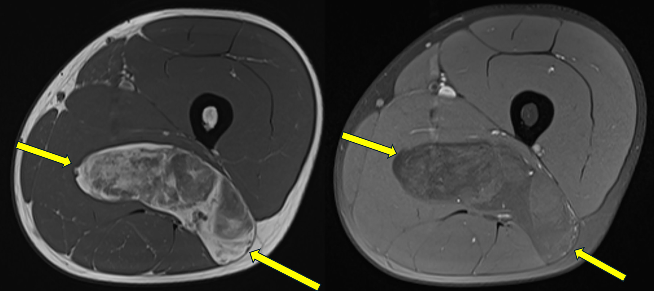 Axial T1-weighted and axial T1-weighted with fat saturation showing heterogeneous mixed signal intensity in the mass (arrows).