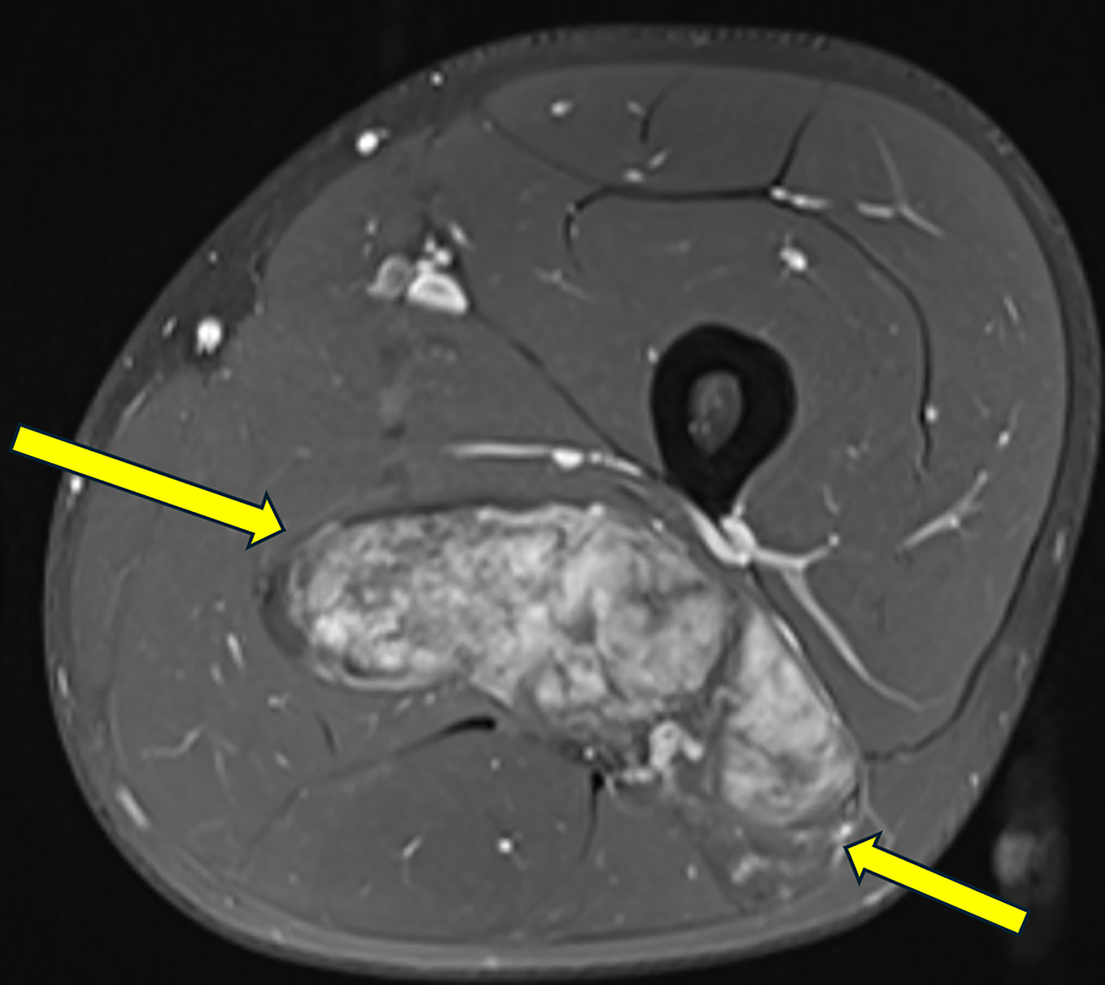 Axial T1-weighted image with fat saturation after intravenous gadolinium contrast showing heterogeneous enhancement of the mass (arrows).