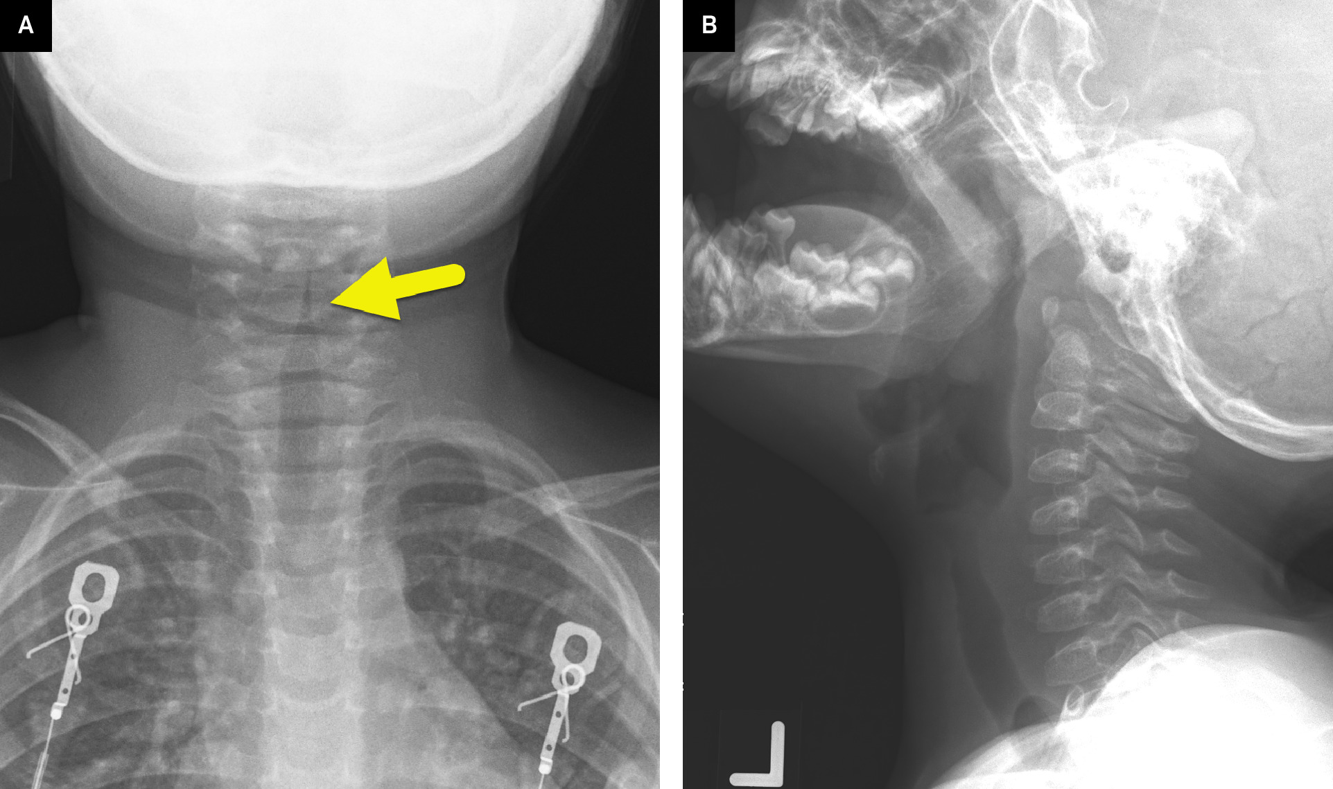(A) Anterior-to-posterior radiograph of the airway showing symmetric narrowing (arrow) of the subglottic trachea creating the “steeple sign.” (B) Lateral radiograph of the airways showing moderate ballooning of the pharynx and ill-definition of the larynx and subglottic trachea.