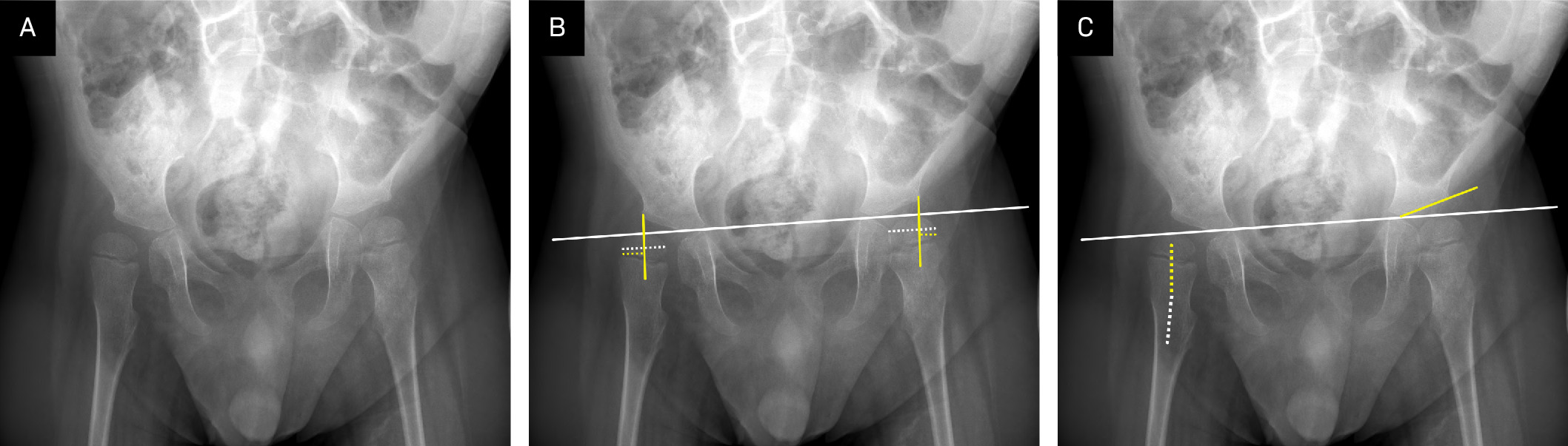 (A) Anteroposterior radiograph of the pelvis showing the hips to have a valgus configuration with lateral uncovering of the femoral heads. (B) The proximal femoral migration percentages can be measured by first drawing the Hilgenreiner line (solid white line) connecting the triradiate cartilage. Next, the Perkin line (solid yellow line) is drawn from the lateral margin of the acetabulum perpendicular to the Hilgenreiner line. Next, the width of the femoral head is measured (white dashed line), along with the length of the femoral head lateral to the Perkin line (yellow dashed line). The proximal femoral migration percentage is calculated by dividing the uncovered length from the total length. (C) The acetabular angle is determined by measuring the angle between the Hilgenreiner line (solid white line) and the line along the acetabular roof (yellow line). The neck-shaft angle is determined by measuring the angle from the center of the femoral head through the center of the femoral neck (yellow dashed line) and a line from the center of the femoral neck through the center of the femoral diaphysis (white dashed line).
