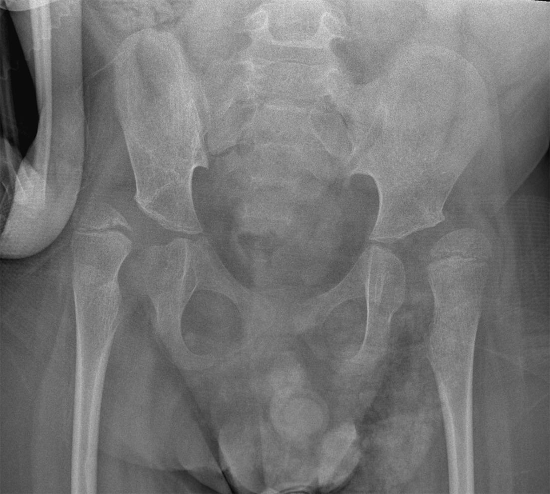 Anteroposterior radiograph of the pelvis performed 2 y later showing dislocation of the right hip and worsening subluxation of the left hip.