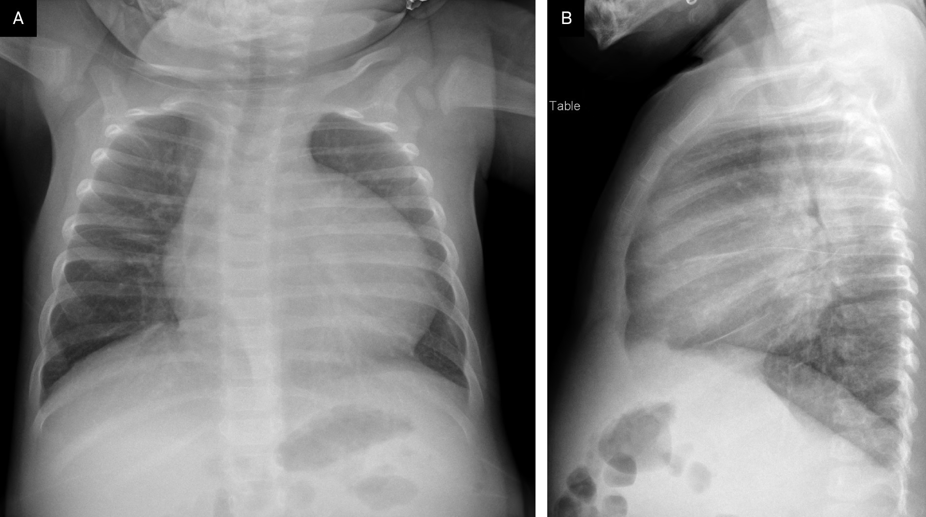(A) Frontal and (B) lateral chest radiograph shows cardiomegaly.