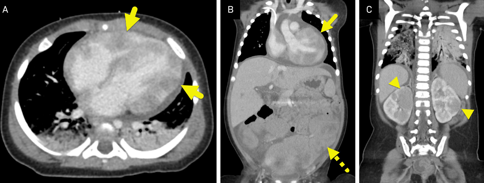 (A) Axial contrast-enhanced CT of the chest and (B, C) coronal CT images show the infiltrative soft tissue chloromas affecting the heart (arrow), mesentery (dashed arrow), and kidneys (arrowhead).