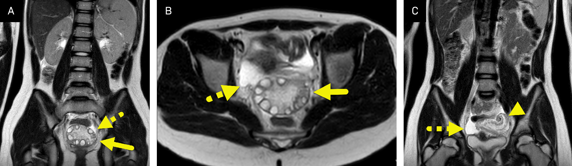 (A) Coronal and (B) axial T2-weighted images showing an enlarged, edematous left ovary (arrow). Small follicles are located at the periphery of the ovary. A small amount of free fluid (dashed arrow) is present adjacent to the ovary. (C) Coronal T2-weighted image showing twisting (arrowhead) of the round ligament and free fluid (dashed arrow).
