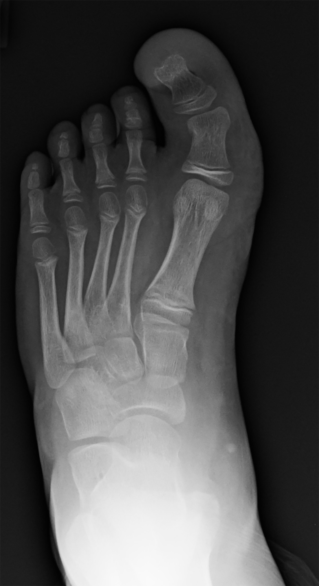 Anteroposterior radiograph of the left foot showing macrodactyly of the entire first ray from the metatarsal through the distal phalanx.