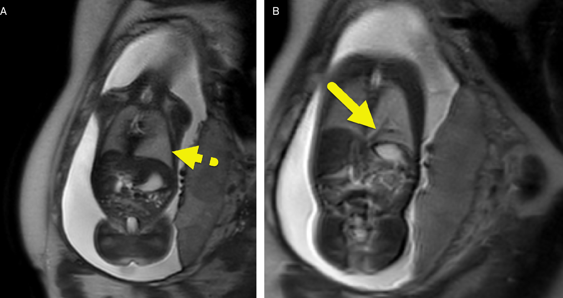 (A) Coronal T2-weighted images from fetal MRI showing a T2 hyperintense mass (dashed arrow) of the left lower lobe. (B) A large feeding vessel (arrow) arises from the aorta.