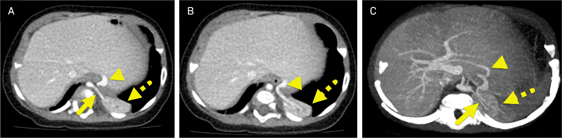 (A) Axial contrast-enhanced chest CT images showing an enhancing mass (dashed arrow) in the left lower lobe. (B) A large supplying artery (arrow) arises from the aorta. The mass is drained by a large vein (arrowhead) that joins with the portal vein. (C) Thick slab maximum intensity projection image highlighting the vascular supply (arrow) and drainage (arrowhead) pathway.
