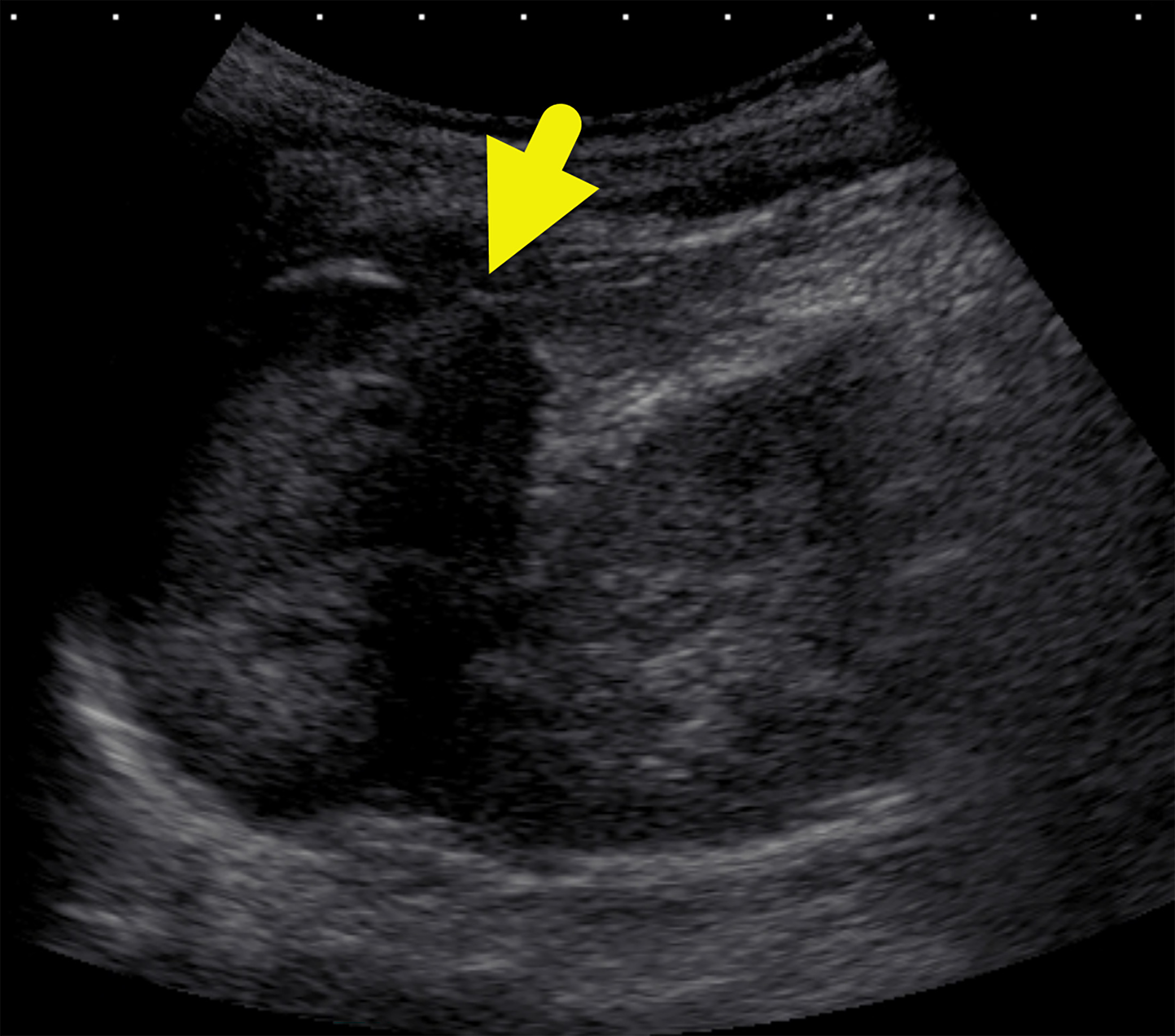 Longitudinal US image of the left kidney showing a solid suprarenal mass (arrow). The mass was isointense to the adjacent kidney.