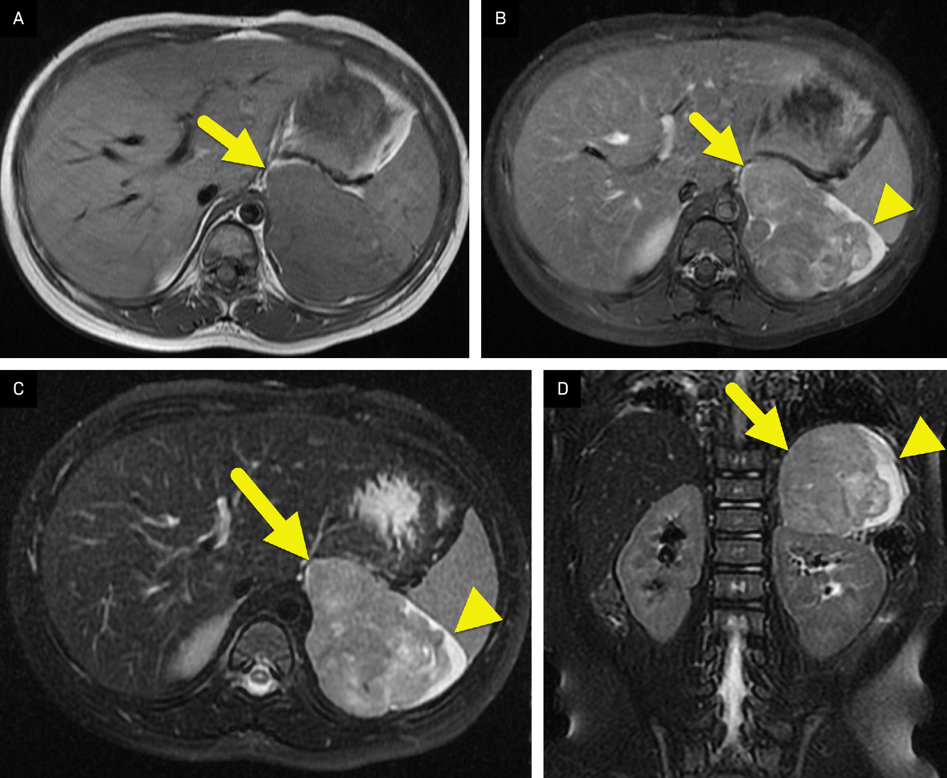 (A) Axial T1-weighted, (B) axial T2 with fat saturation, and (C) axial T1-weighted postcontrast images showing the large left suprarenal mass (arrow). The mass is isointense to the spleen on the T1-weighted image, hyperintense on the T2-weighted image, and has minimal enhancement. Nontumoral adrenal tissue (arrowhead) is present at the periphery of the mass. (D) Coronal T2-weighted image highlighting the left suprarenal mass (arrow) and adjacent adrenal tissue (arrowhead). The mass displaces the kidney inferiorly.