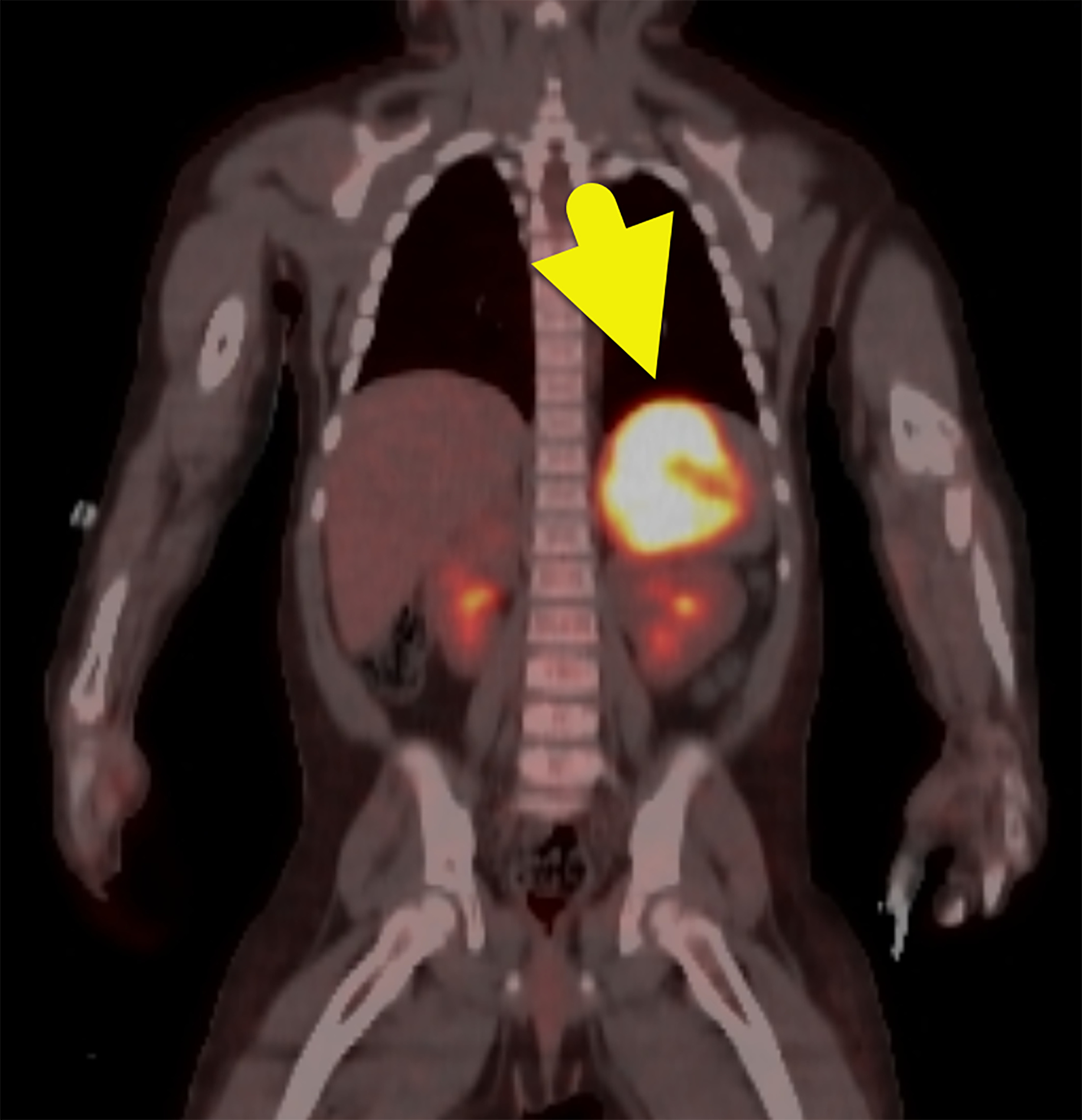F-18 fluorodeoxyglucose (FDG) PET-CT showing the left suprarenal mass (arrow) to be FDG-avid, with a maximum standardized uptake value of 17.