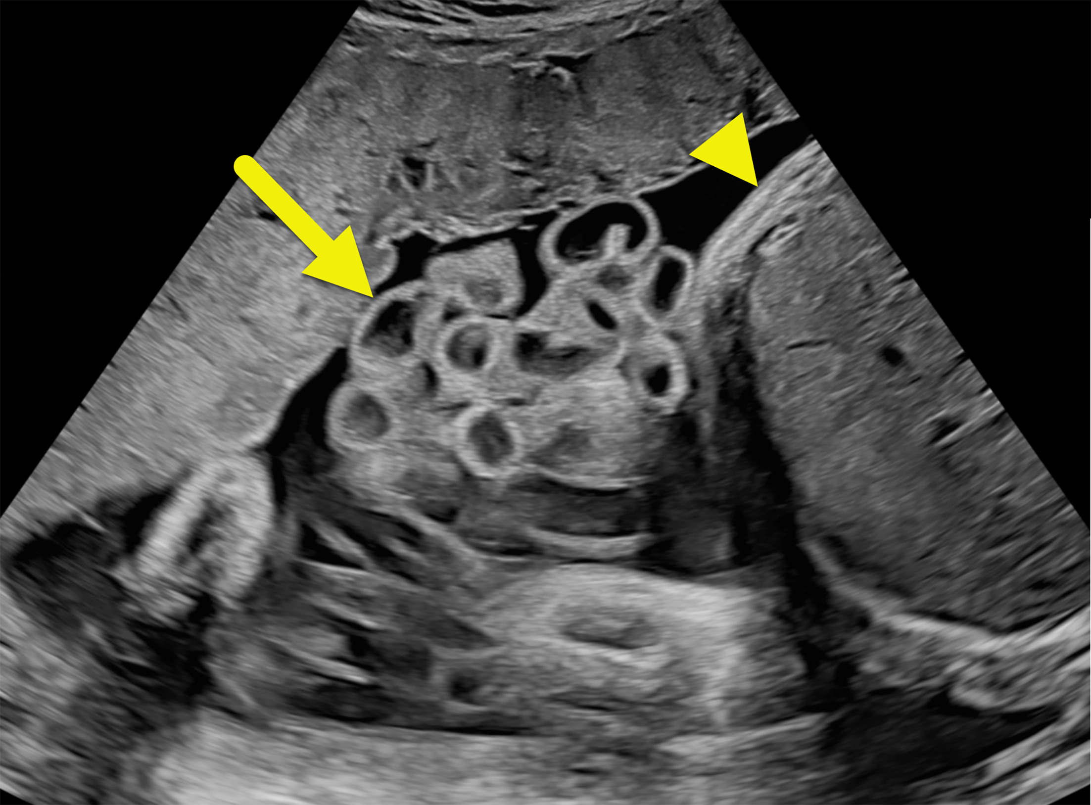 Fetal US image showing dilated and mildly thickened loops of bowel (arrow) external to the abdomen (arrowhead).