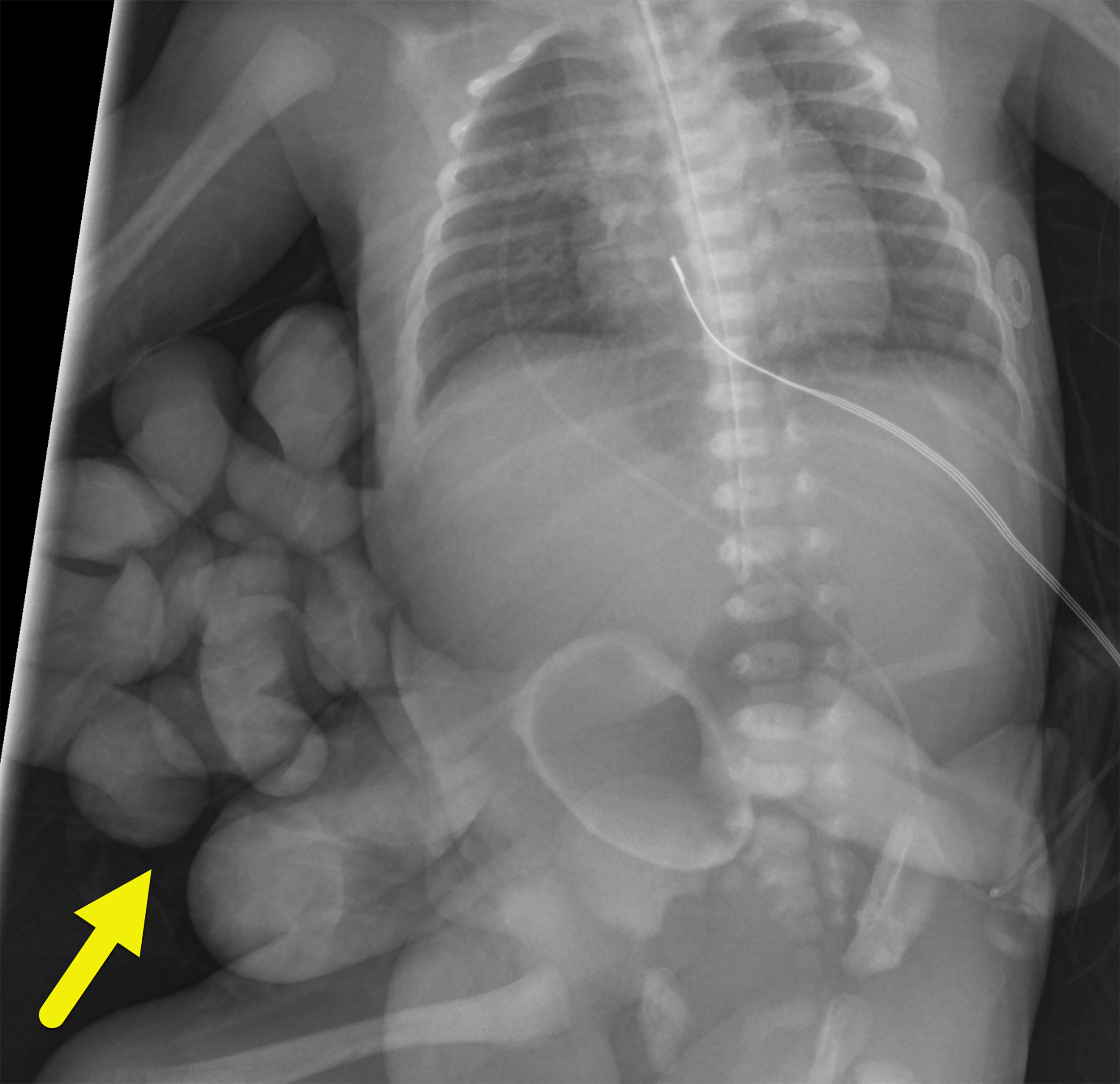 Abdominal radiograph showing eviscerated bowel (arrow) external to the abdomen.
