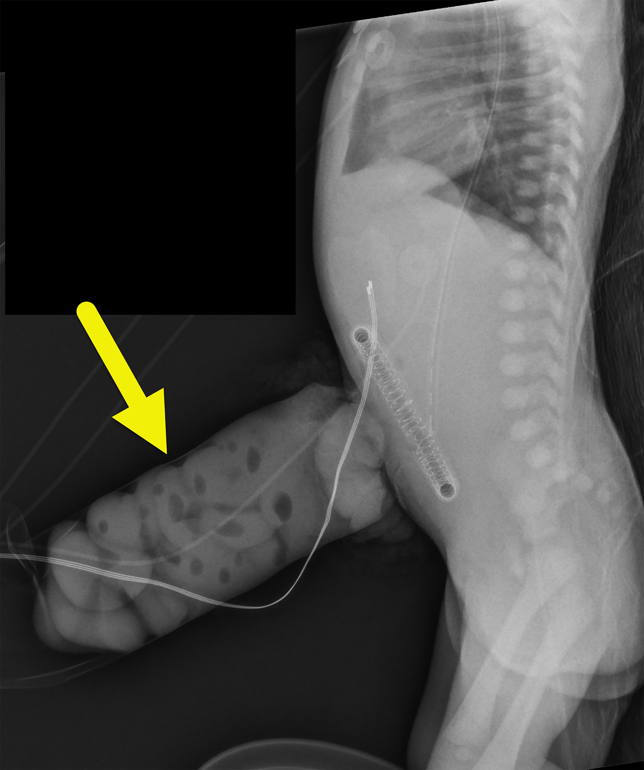 Abdominal radiograph performed 2 hours later showing the eviscerated bowel (arrow) within an abdominal silo.