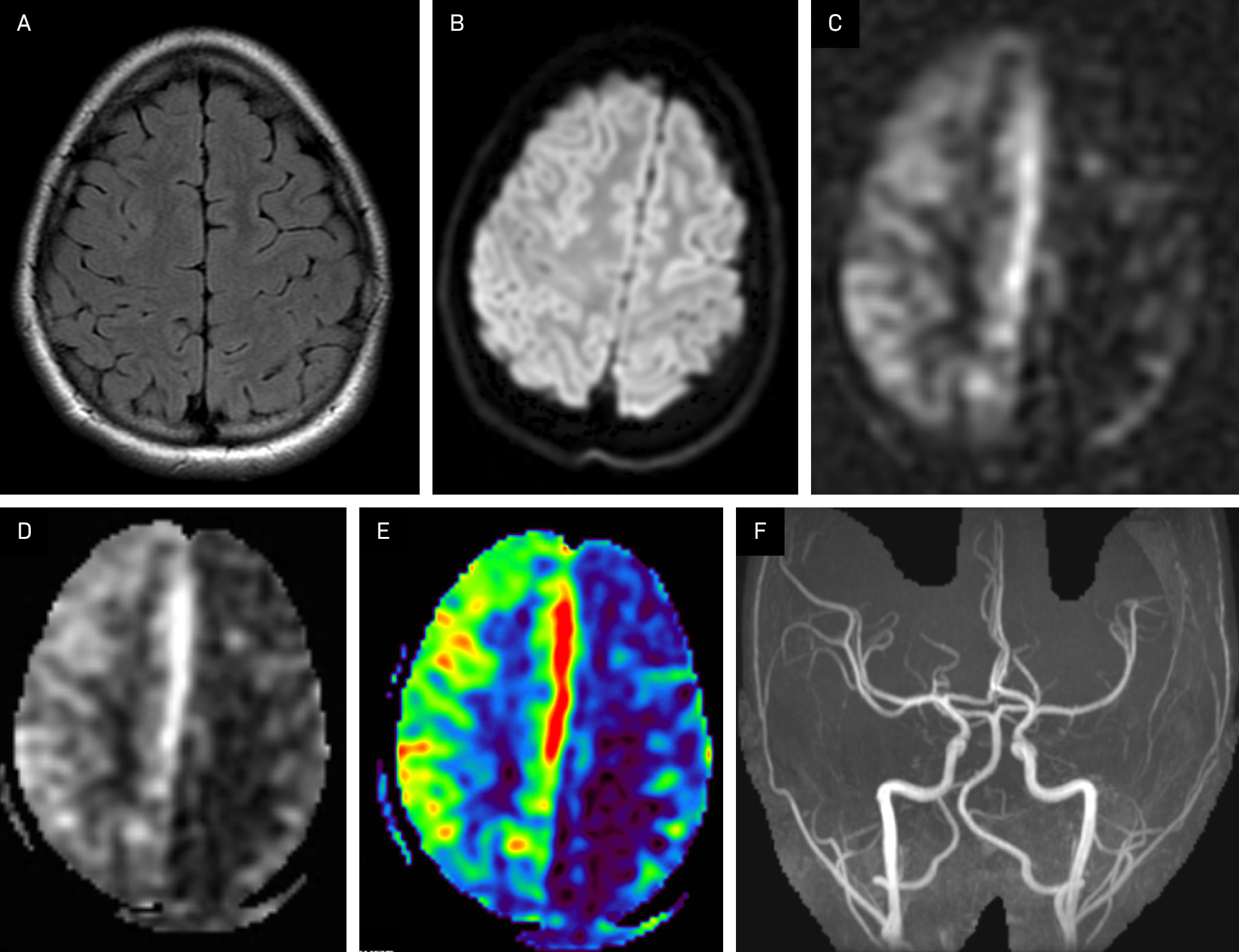 (A) Axial FLAIR and (B) diffusion-weighted images of the cerebral hemispheres are normal. (C) Three-dimensional ASL, (D) cerebral blood flow, and (E) color ASL images at the same level show severe decreased perfusion to the entire left hemisphere. (F) Coronal maximum intensity projection image from MR angiography shows normal cerebral vasculature.