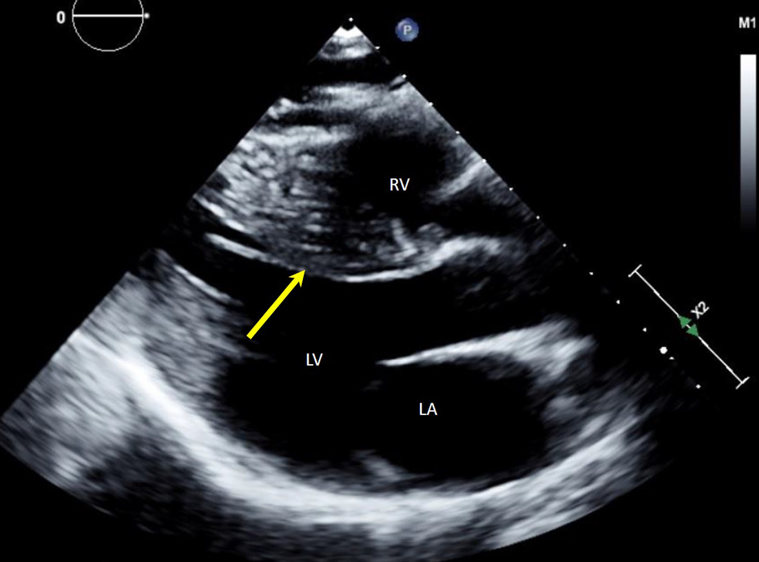 Two-dimensional parasternal long-axis transthoracic echocardiogram at end diastole showing severe asymmetric left ventricular hypertrophy of the septal wall (yellow arrow). LA, left atrium; LV, left ventricle; RV, right ventricle.