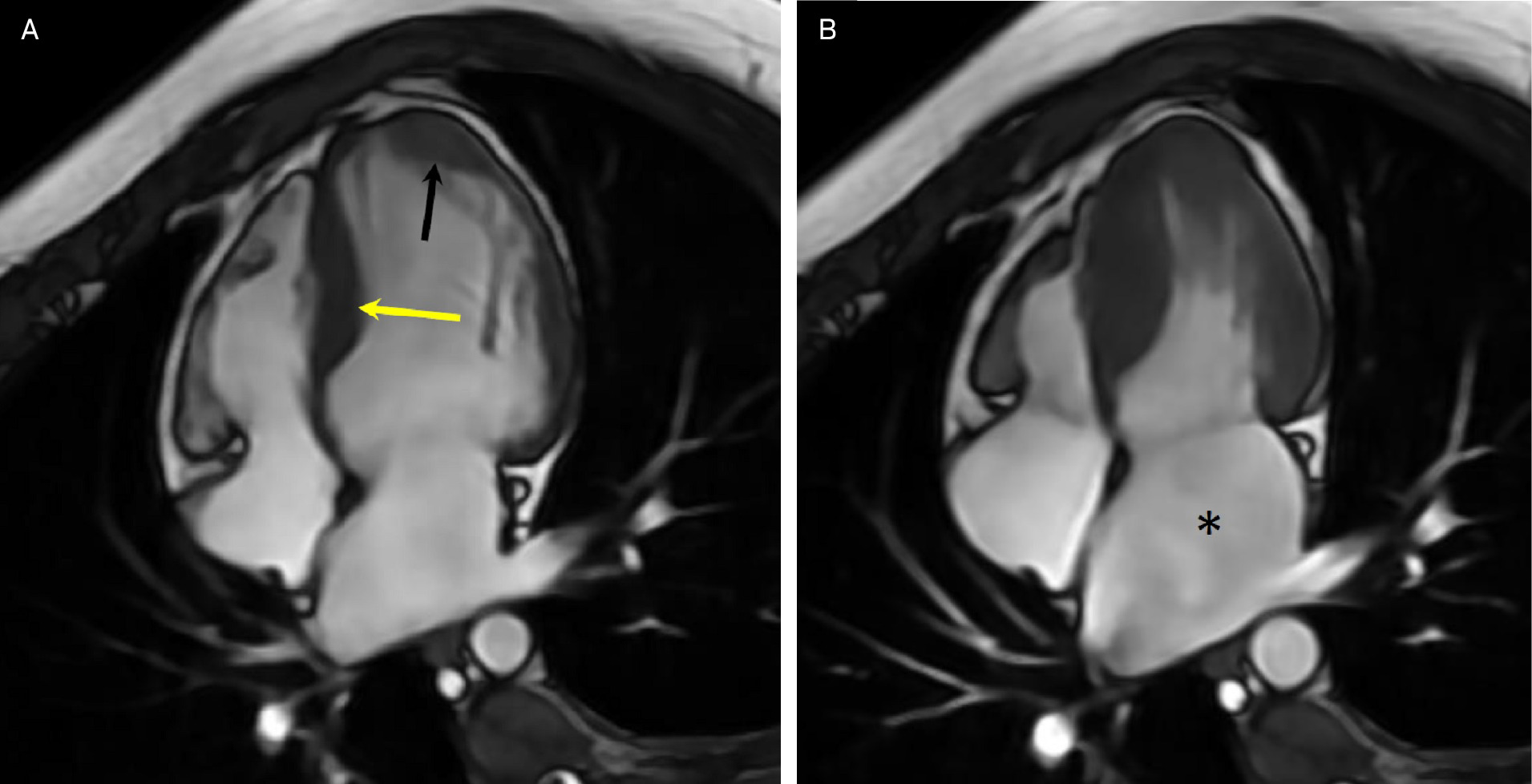(A) Four-chamber cardiovascular magnetic resonance (CMR) cine steady-state-free precession (SSFP) at end diastole showing severe asymmetric left ventricular hypertrophy of the septal wall (yellow arrow) and apical lateral wall (black arrow). (B) Four-chamber CMR cine SSFP at end systole showing severe asymmetric left ventricular hypertrophy of the septal and apical lateral walls (yellow arrow) with normal left ventricular systolic function and near mid-left ventricular cavity obliteration and severe left atrial dilation (black asterisk).