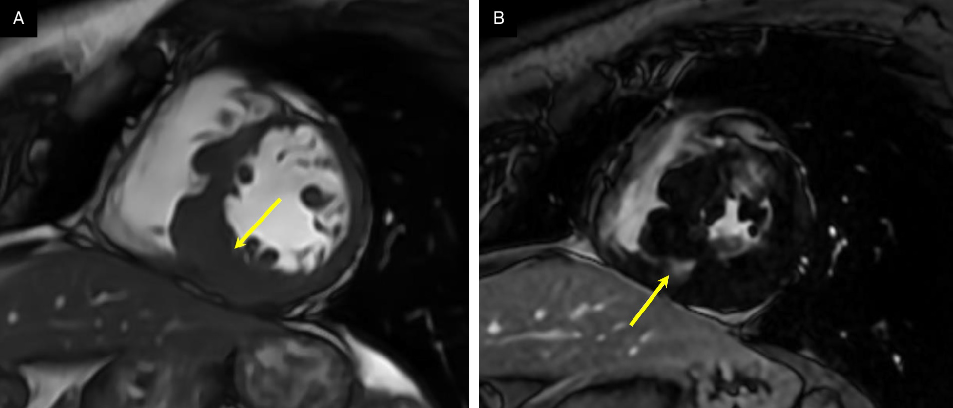 (A) Three-chamber mid-short-axis cardiovascular magnetic resonance (CMR) cine steady-state-free precession at end diastole showing severe mid-inferoseptal wall hypertrophy (yellow arrow) and gradient recalled echo (GRE) post-contrast at end diastole showing extensive patchy mid-myocardial late gadolinium enhancement (LGE) of the anteroseptal wall (yellow arrow). (B) Mid-short-axis CMR GRE post-contrast at end diastole showing patchy mid-myocardial LGE of the mid-anteroseptal inferoseptal wall (yellow arrow).