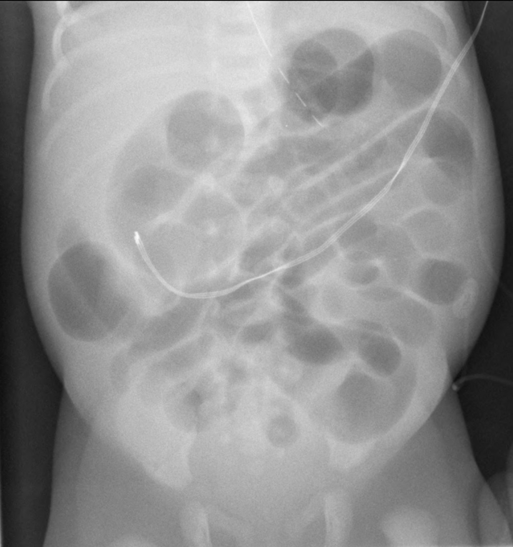 Abdominal radiograph showing dilated and distended air-filled loops of bowel with a distal obstructive pattern. No gas is visible within the rectum.