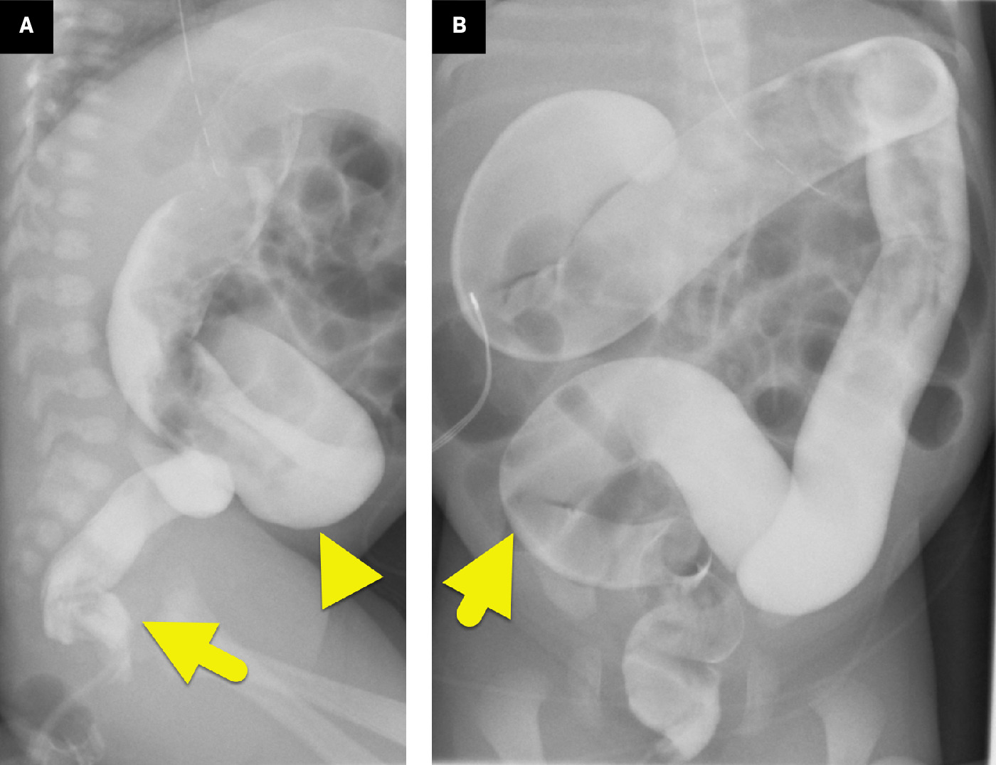(A) Lateral image from a contrast enema showing a small caliber of the rectum (arrow). The more proximal sigmoid colon (arrowhead) is dilated to a greater degree than the rectum, giving an abnormal rectosigmoid ratio. (B) Frontal image from the enema showing a transition zone (arrow) from the dilated proximal colon to the narrower distal sigmoid colon.