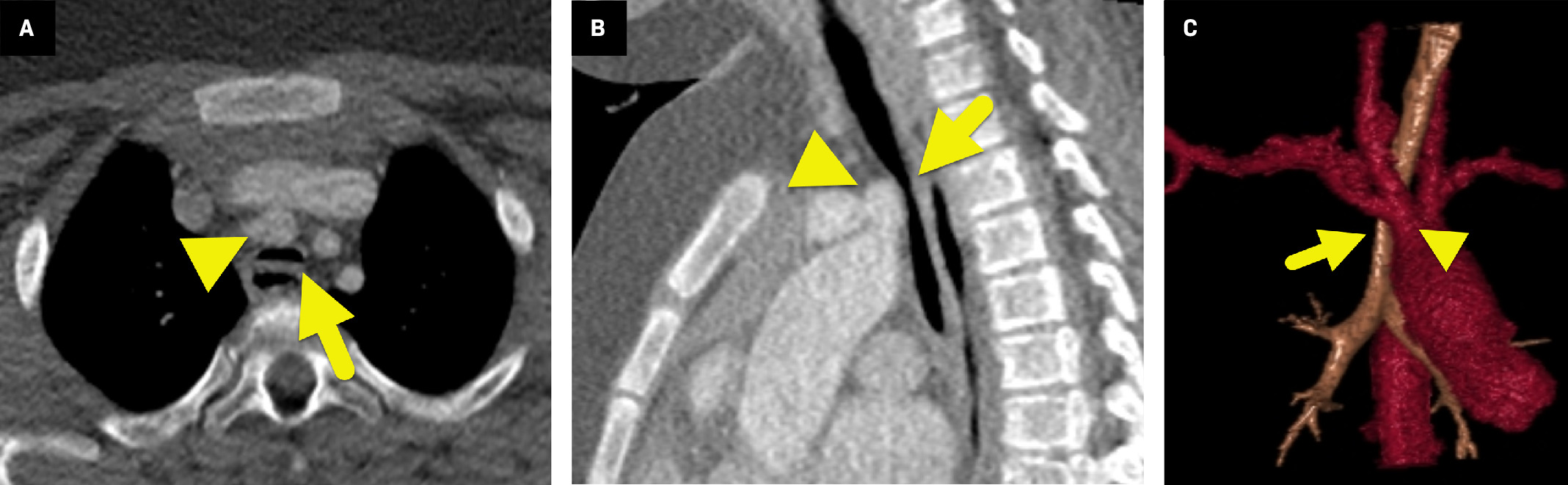 (A) Axial, (B) sagittal, and (C) three-dimensional reformatted images from contrast-enhanced CT show severe narrowing of the trachea (arrow) as the brachiocephalic artery (arrowhead) passes anteriorly into the right.