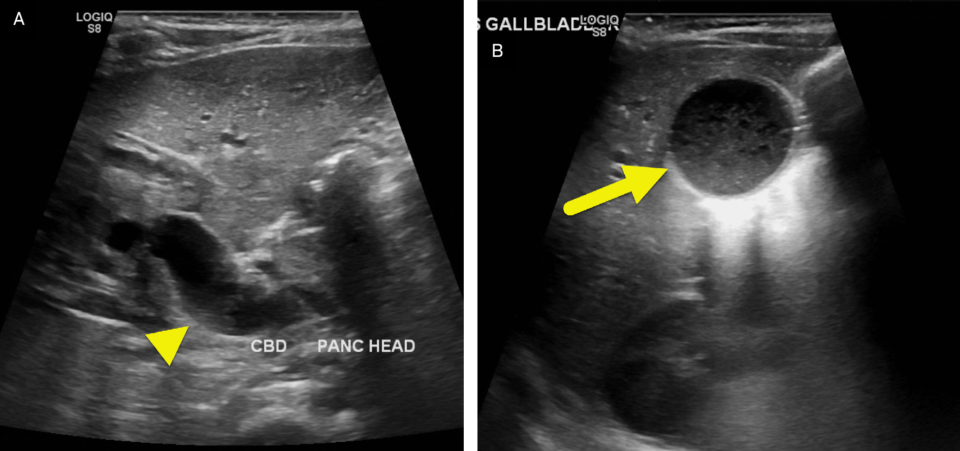 (A) US of the right upper quadrant showing marked dilation of the common bile duct (arrowhead) with debris in the duct and (B) gallbladder lumen (arrow). The gallbladder was markedly distended.