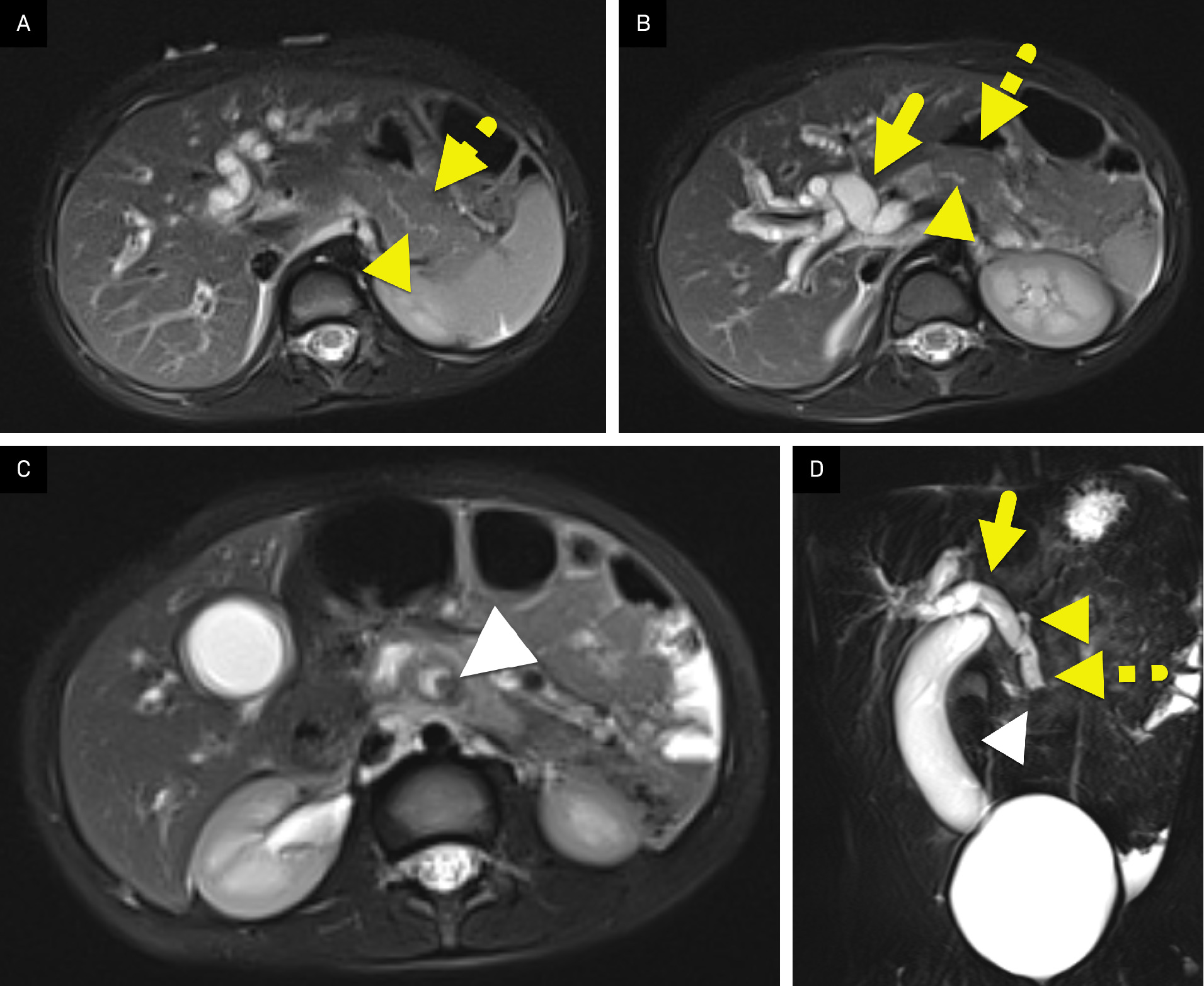 (A-C) Axial T2-weighted images showing the findings of acute interstitial pancreatitis with an edematous pancreas (dashed arrow), peripancreatic edema, a dilated pancreatic duct (arrowhead), and a filling defect within the distal common bile duct (white arrowhead). Intra- and extrahepatic bile ducts are markedly dilated (arrow). (D) Coronal maximum intensity projection reconstructed image from MR cholangiopancreatography showing that the pancreatic duct (arrowhead) joins the common bile duct (arrow) approximately 3 cm from the duodenum. There is a long common channel (dashed arrow). The distal duct abruptly terminates due to a filling defect (white arrowhead).