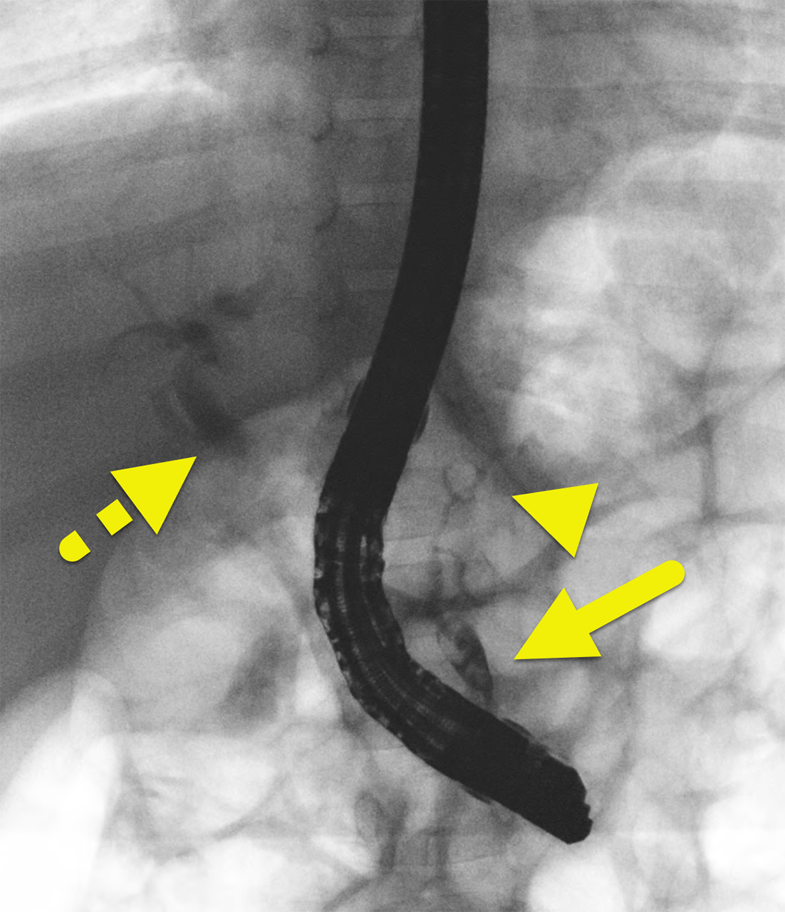 Endoscopic retrograde cholangiopancreatography showing filling defects within the long common channel (arrow). The pancreatic duct (arrowhead) and common bile duct (dashed arrow) are visible. During the procedure, a balloon was used to clear the duct. A biliary stent was placed.