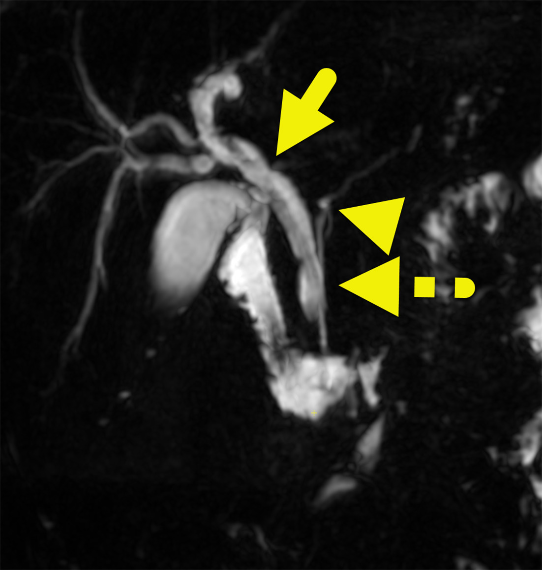 Repeat MR cholangiopancreatography showing similar findings of a type 4 choledochal cyst with dilated intra- and extrahepatic bile ducts (arrow), as well as an anomalous pancreaticobiliary junction. The pancreatic duct (arrowhead) joins the common bile duct forming a long common channel (dashed arrow).