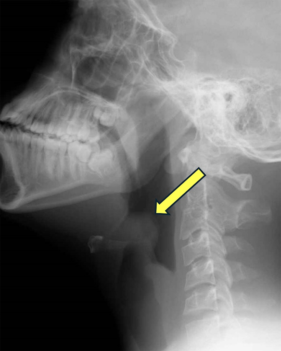 Seated lateral neck radiograph demonstrating an enlarged epiglottis (yellow arrow) and thickened aryepiglottic folds bilaterally (arrowheads). The hypopharynx is distended, and the cervical spine is straightened to help maximize the laryngeal opening.