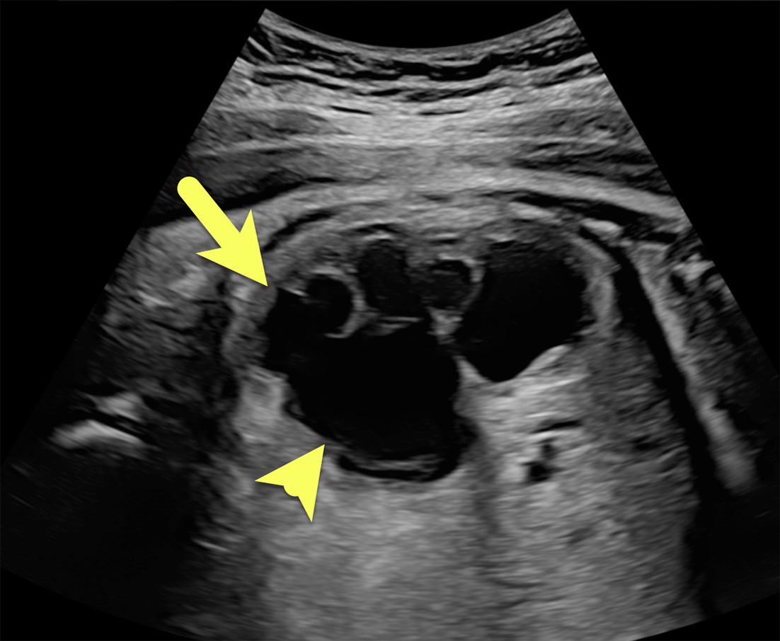 Fetal US at 35 weeks’ gestation demonstrates severe dilation of the right renal pelvis (arrowhead) with associated central and peripheral calyceal dilation (arrow).