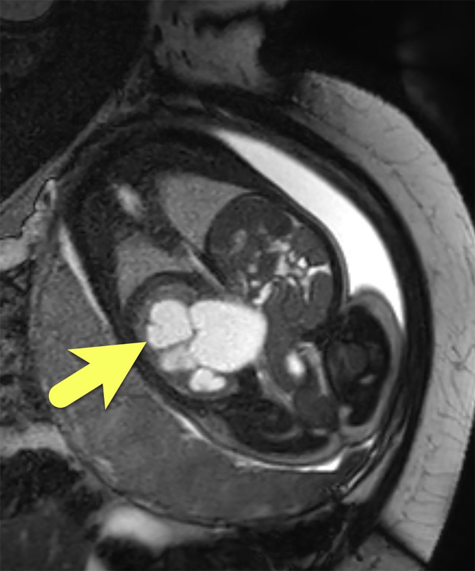 Fetal MRI demonstrates severe right pelvocaliectasis with marked calyceal dilation (arrow). No hydroureter is identified.