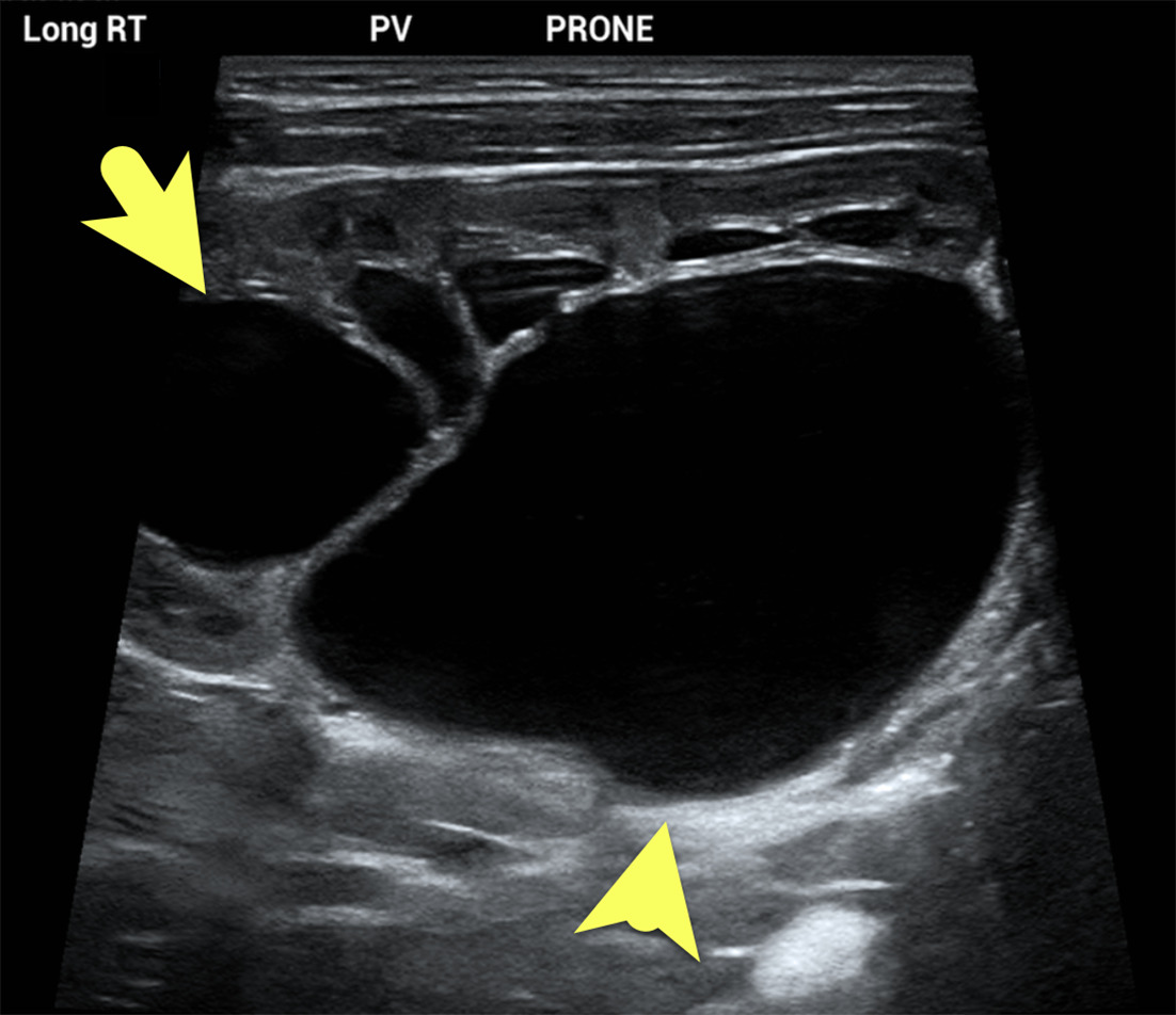 Postnatal renal US performed at 1 month of life demonstrates severe right pelvocaliectasis with dilation of the renal pelvis (arrowhead) and intrarenal calyces (arrow). No hydroureter is present.