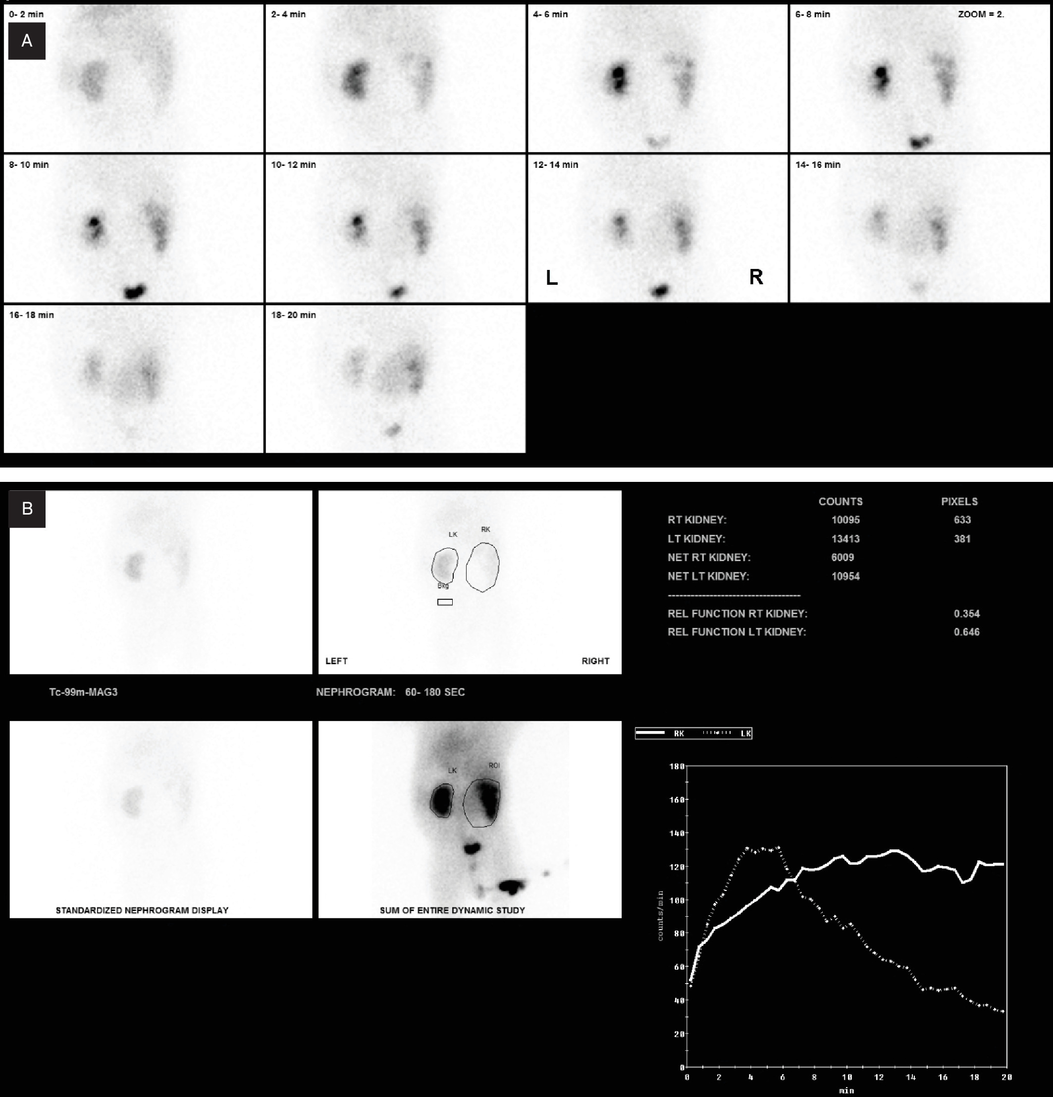 (A) Posterior projection from dynamic images from technetium Tc-99m mercaptoacetyltriglycine diuretic renography demonstrates prompt radiotracer uptake and spontaneous drainage of the left kidney. The right kidney shows delayed parenchymal uptake and excretion. (B) On the renogram curve, the left kidney (dashed line on curve) demonstrates normal washout, whereas the right kidney (solid line on curve) shows delayed parenchymal washout and continued accumulation of tracer within the collecting system, consistent with obstruction. The T½ of the right kidney measured 87 minutes.