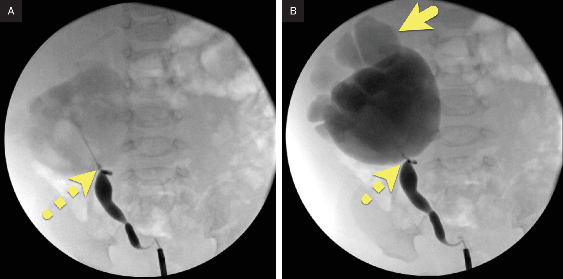 Intraoperative ureteroscopy images demonstrate cannulation of the right ureter with contrast injection. (A) A jet of contrast (dashed arrow) fills the markedly dilated right renal pelvis. (B) With continued injection, the collecting system opacifies, and markedly dilated calyces (arrow) are visualized.