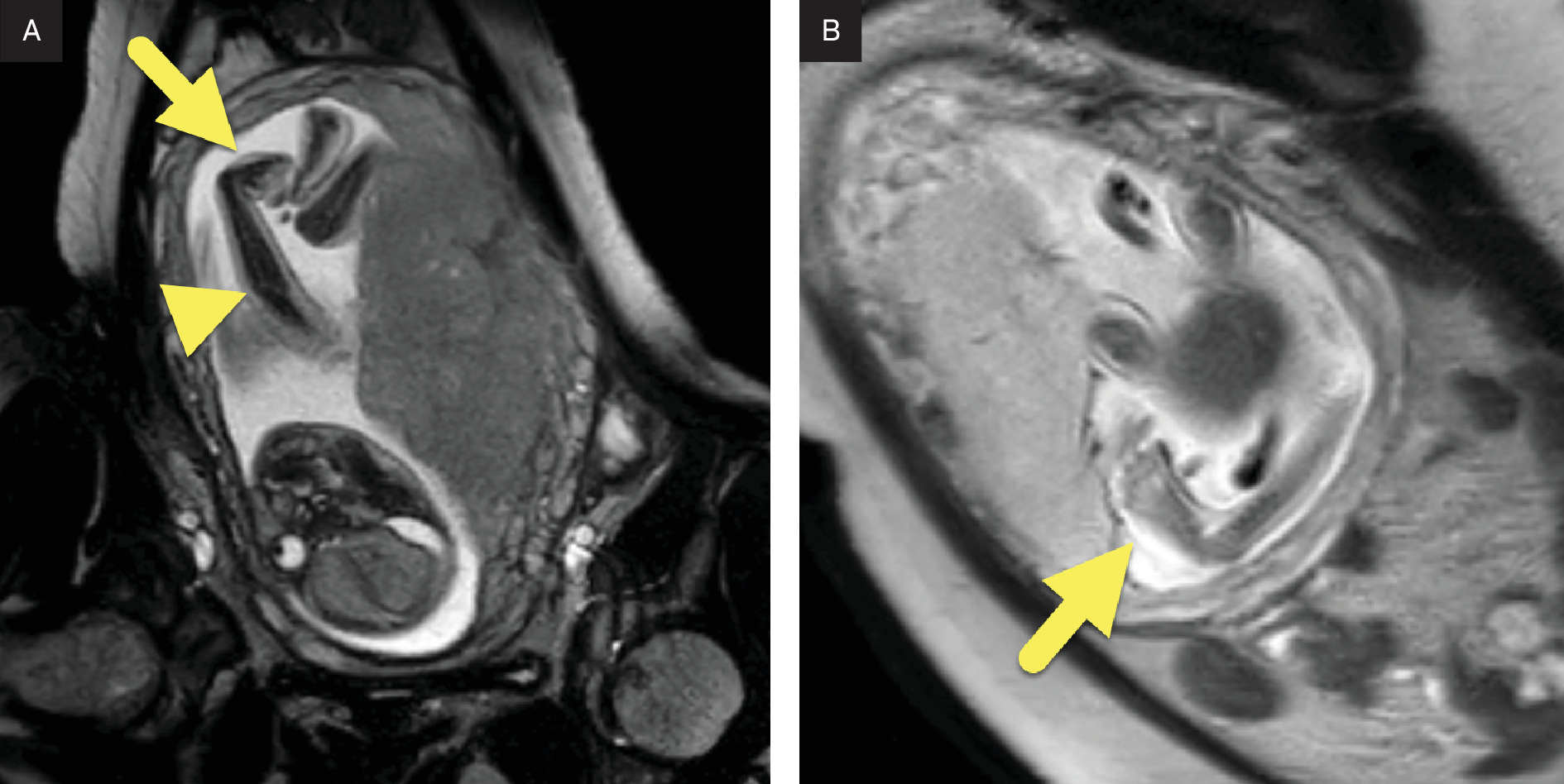 Fetal MRI performed at 25 weeks of gestational age showing (A) fixed extension of the elbow (arrowhead) and flexion of the wrist (arrow). (B) Imaging of the left lower extremity showing a club foot (arrow).
