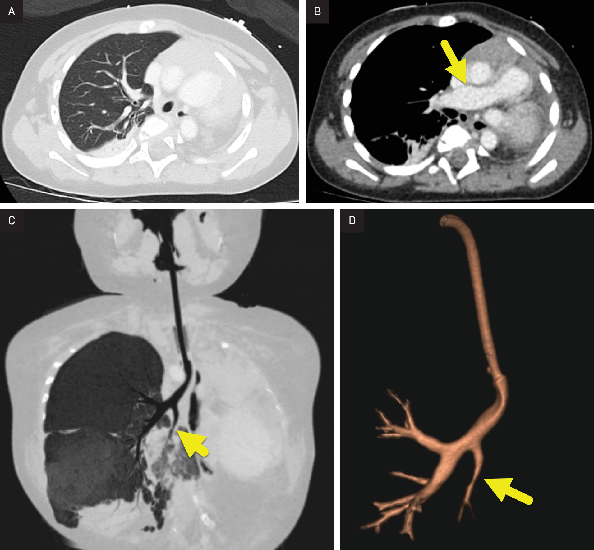 (A) Axial contrast-enhanced CT of the chest in lung windows showing a hyperinflated right lung and absence of the left lung. There is a leftward shift of the heart and mediastinum. (B) Axial contrast-enhanced CT of the chest in soft tissue windows showing the right pulmonary artery (arrow) and absence of the left pulmonary artery. (C) Coronal minimum intensity projection image and (D) 3D-reformatted image of the airway highlighting the trachea and right mainstem bronchus. The right lower lobe bronchus (arrow) arises from the mainstem bronchus. There is no left mainstem bronchus.