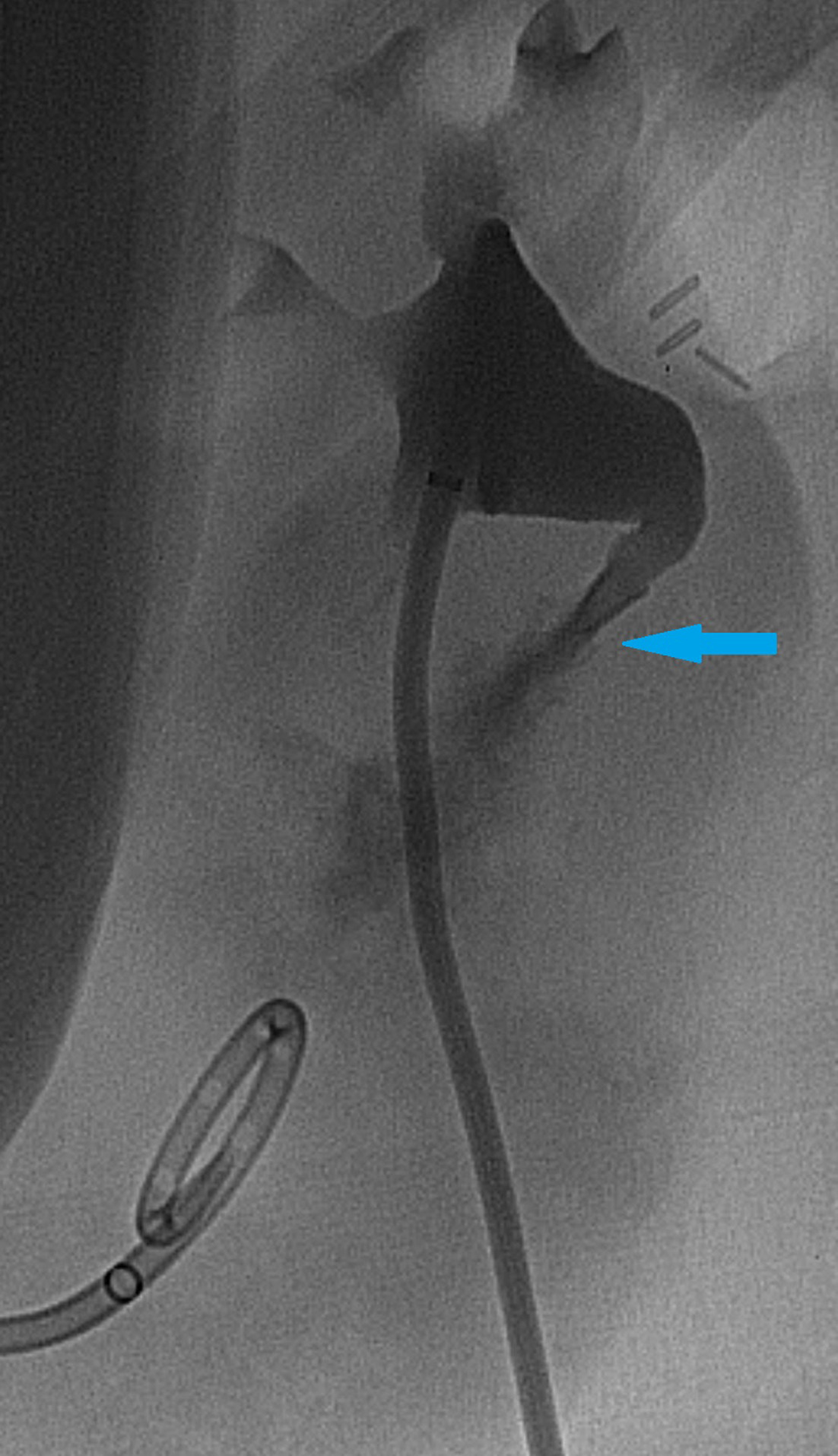 Fluoroscopic save image during contrast injection of the newly placed nephrostomy tube, with extravasation of contrast from the proximal ureter into the urinoma (blue arrow).