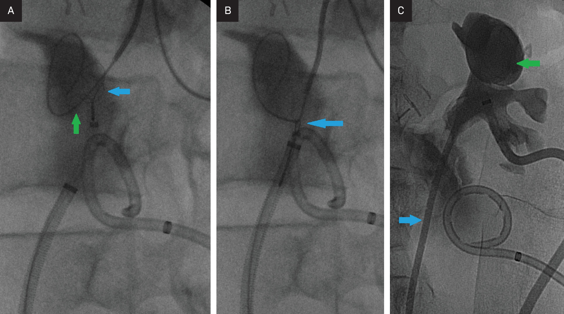 Fluoroscopic save images during percutaneous intubated ureterotomy. (A) The loop snare is open (blue arrow) in the urinoma and placed through the retrograde sheath, with the antegrade wire traversing the open snare (green arrow). (B) The snare is closed around the wire (blue arrow), and the wire is being withdrawn into the retrograde sheath. (C) Double-J ureteral stent traversing the distal and proximal ureter (blue arrow) with the proximal loop in the upper pole calyx (green arrow), which is opacified with contrast.
