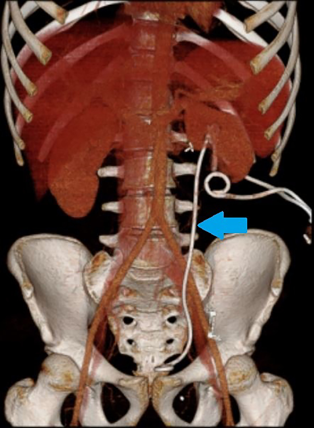 CT 3D rendering of the left double-J ureteral stent (blue arrow), obtained 1 day after placement, with the proximal stent loop in the intrarenal collecting system and the distal loop in the urinary bladder.