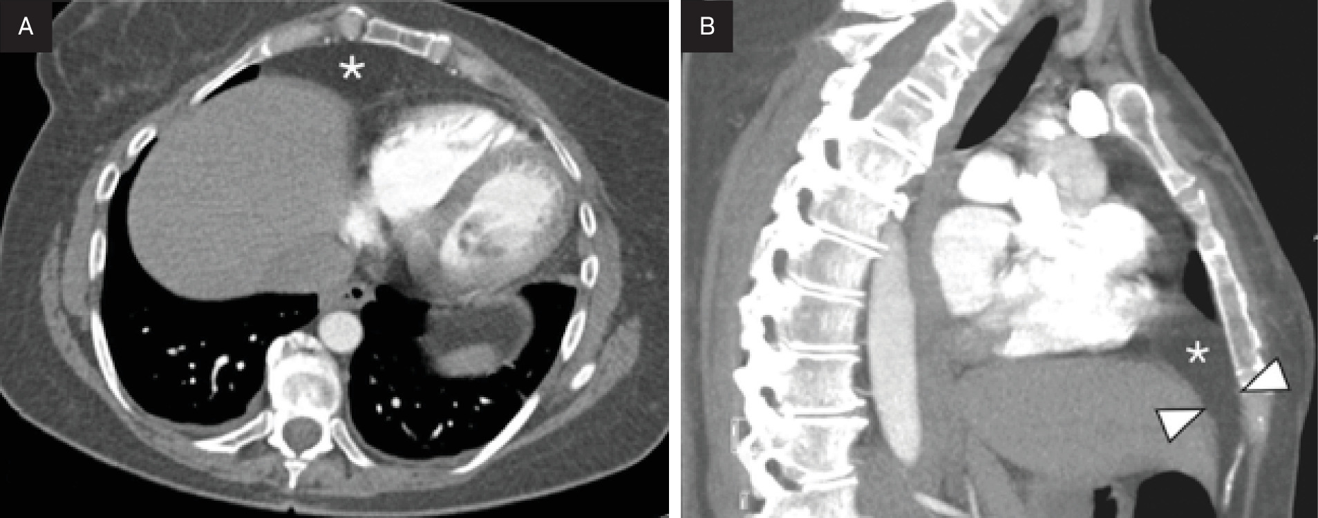 (A) An axial CT section through the lower chest, obtained 3 years after Figure 1, demonstrating omental fat (asterisk) that has herniated into the anterior mediastinum. (B) A mid-sagittal section from the same study showing the omental fat herniating through the anterior defect in the diaphragm (arrowheads) that defines a Morgagni hernia.