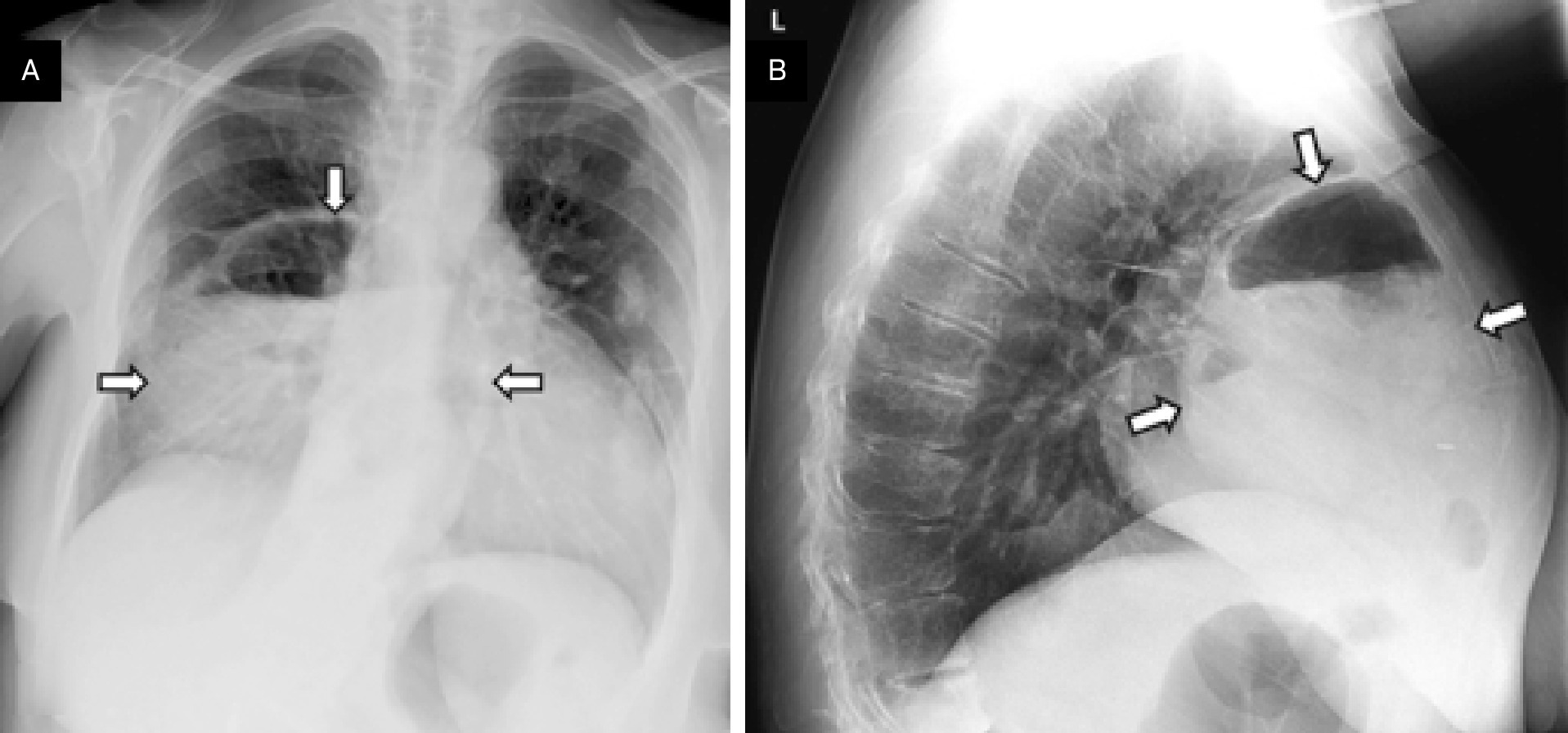 Posteroanterior (A) and lateral (B) chest radiographs obtained 10 years after Figure 1 showing the significant interval increase in the size of the Morgagni hernia (arrows), now containing transverse colon and loops of small bowel in addition to omental fat.