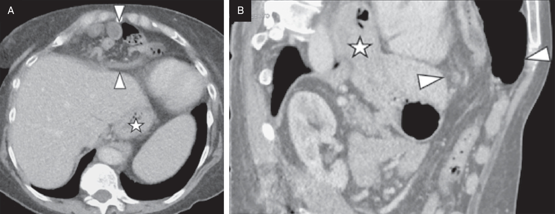 Axial (A) and mid-sagittal (B) abdominopelvic CT sections obtained 10 years after Figure 1 showing the significant interval increase in size of the Morgagni hernia (outlined by arrowheads), located in the right anterior mediastinum, through the expanding sub-costosternal diaphragmatic defect. Note is made of a coexisting paraesophageal hernia (star), with approximately 40% of the stomach within the thoracic cavity.