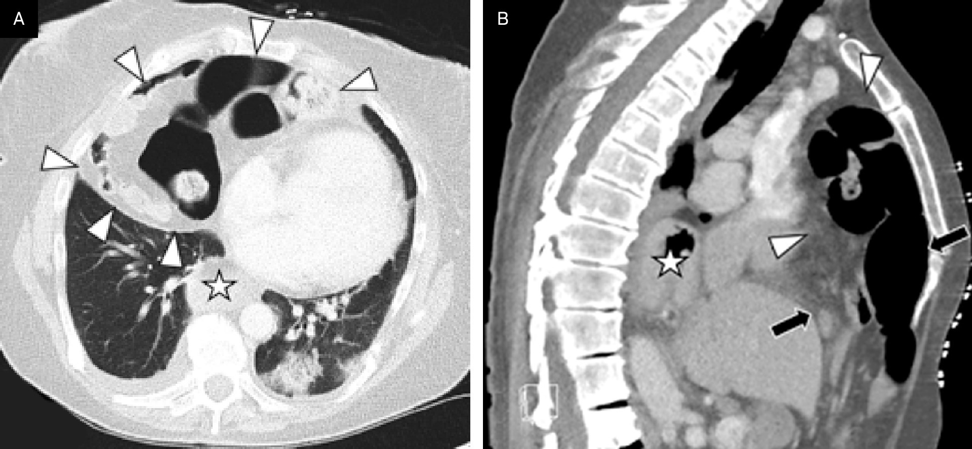 Axial (A) and mid-sagittal (B) chest CT sections obtained 1 month after Figure 4 demonstrating the intrathoracic extent of the Morgagni hernia (arrowheads) containing loops of colon and small bowel and extending through the developmental defect (black arrows) between the pars tendinalis and the pars sternalis of the diaphragm.