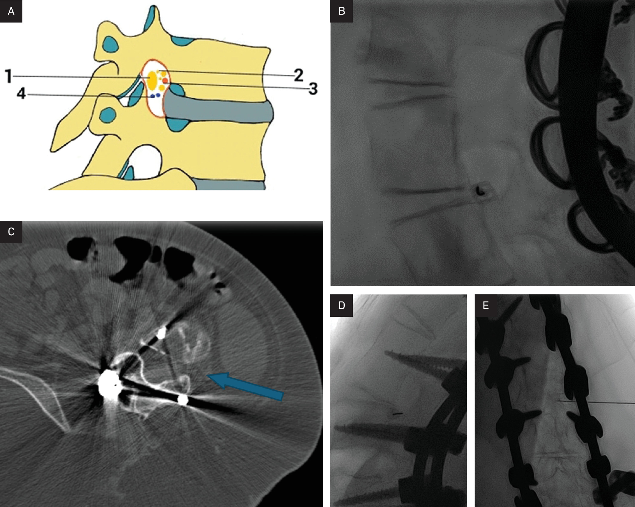 (A) CT axial image of the lumbar spine demonstrating planned left transforaminal access (blue arrow) for intrathecal (IT) nusinersen administration. 1) Segmental spinal nerve/dorsal root ganglion, 2) Sinuvertebral nerves and rami communicantes, 3) spinal branch of segmental arteries, 4) intervertebral veins. (B) Lateral fluoroscopic view of the lumbar spine with the spinal needle (blue arrow) entering the inferior-most aspect of the neural foramen for IT nusinersen, to avoid the neurovascular bundle in the upper 2/3 of the foramen. (C) Frontal fluoroscopic image demonstrating that the spinal needle tip (blue arrow) is near the midline of the thecal sac. (D,E) showing the needle in the inferior aspect of the neuroforamina with the needle tipin the midline.