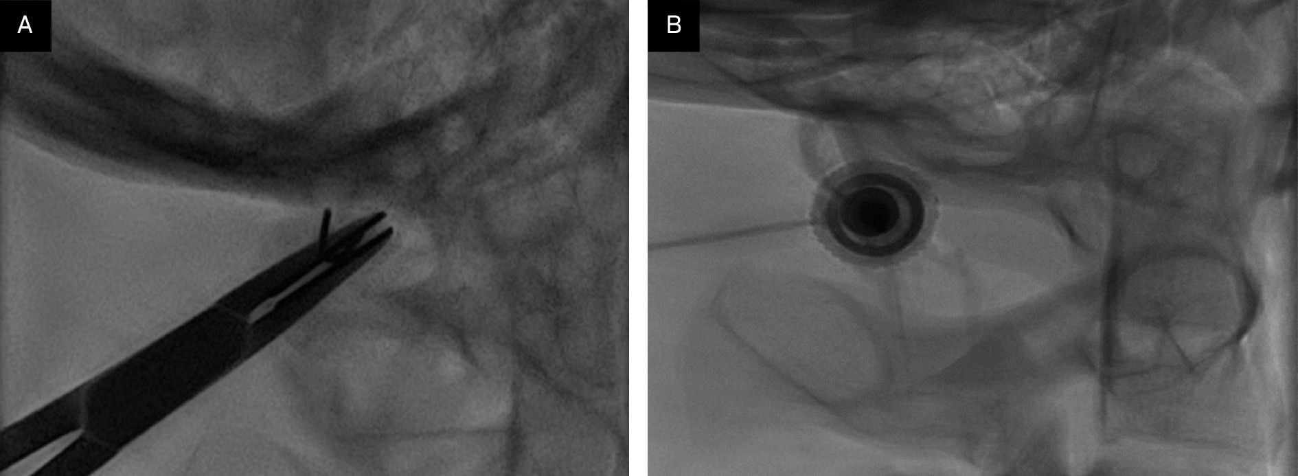 C1-2 puncture. (A) A fluoroscopic image with the patient in supine position selecting the skin entry site. The needle is over the spinolaminar line just below the skull base. (B) Using intermittant biplane fluoroscopy the needle is guided into the cervical subarachnoid space with the needle tip at midline.