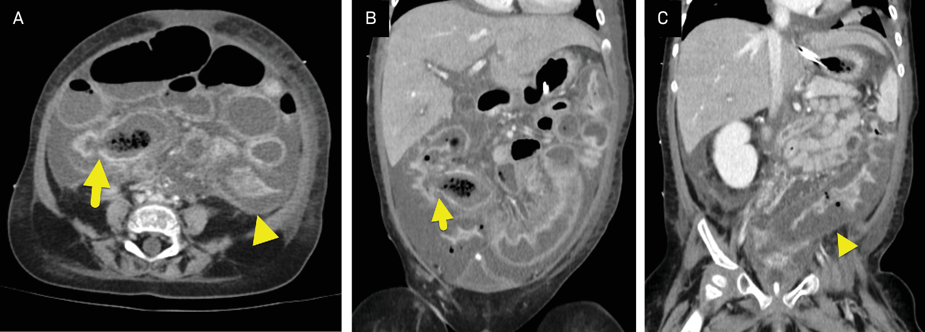 (A) Axial and (B, C) sequential coronal images from an abdominal CT showing massive bowel wall thickening extending from the terminal ileum (arrow) through the descending colon (arrowhead) and rectum (not shown). Moderate ascites was also present.