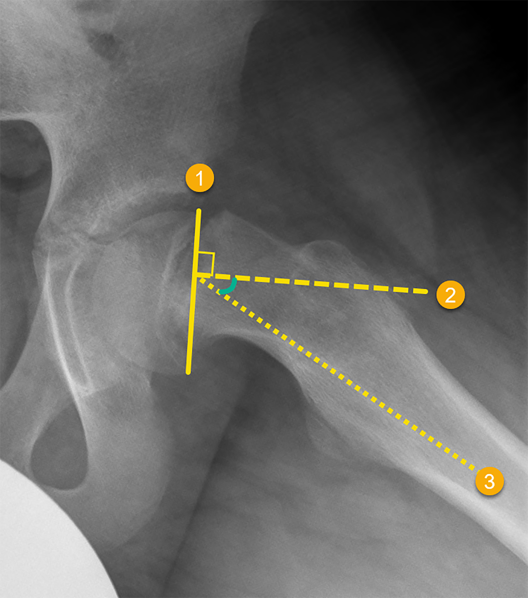 Frog-leg lateral view of the pelvis showing how to calculate the Southwick angle. The first line (1) is drawn connecting the epiphyseal margins, a second line (2) is drawn perpendicular to the first, and, finally, a third line (3) is drawn from the intersection of the perpendicular lines along the axis of the femoral diaphysis. This value is then compared with the corresponding angle on the contralateral side, and the difference yields the final Southwick angle.