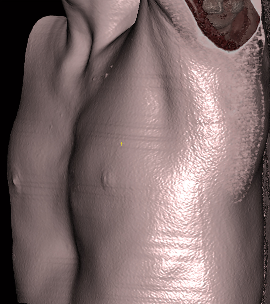 Three-dimensional reconstruction from a chest CT highlighting the pectus excavatum deformity.