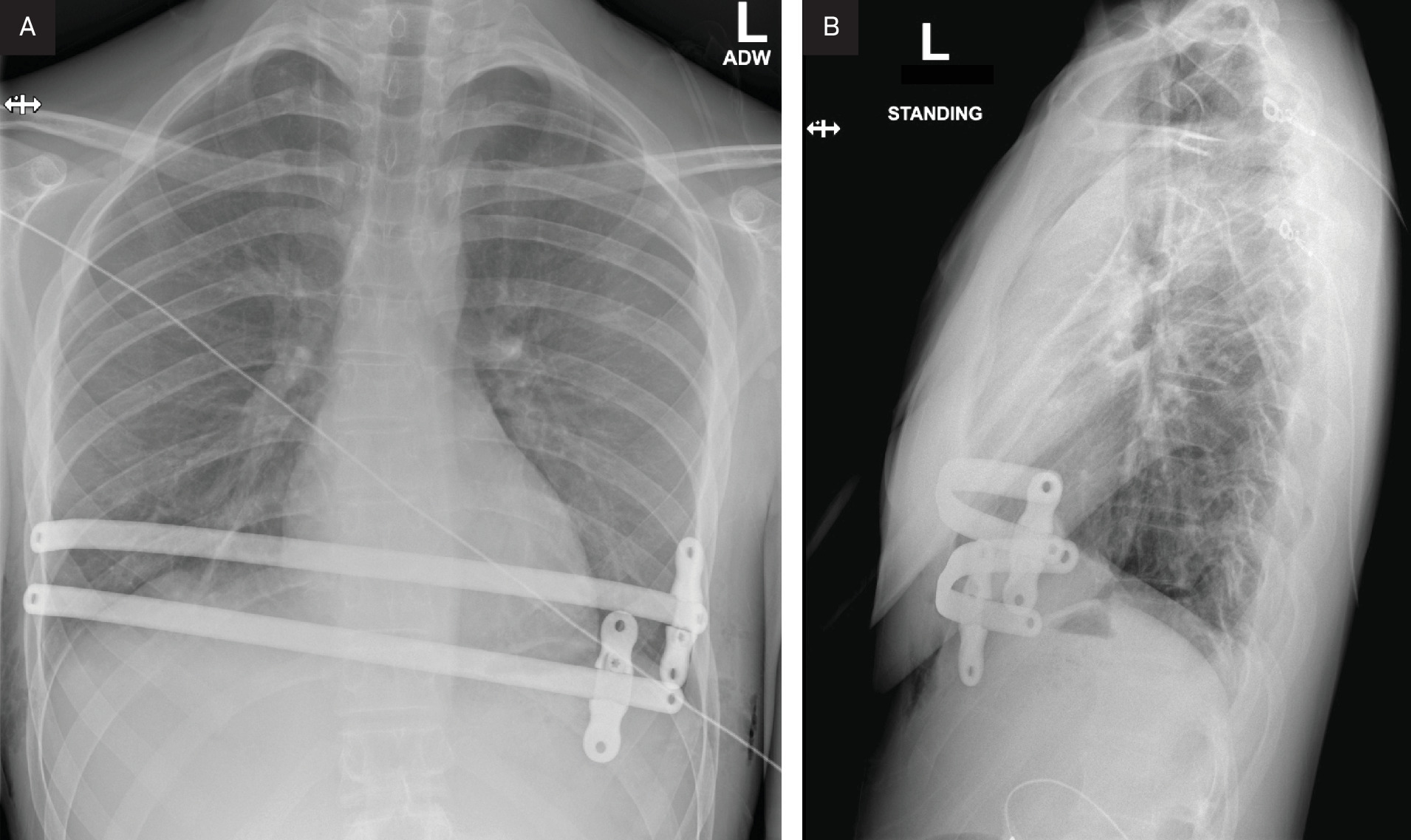 (A) Frontal and (B) lateral chest radiographs after corrective surgery show ing the placement of 2 bars correcting the pectus excavatum deformity.